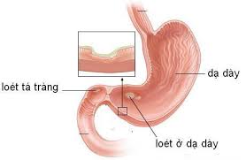 Bài thuốc chữa đau dạ dày do vị nhiệt